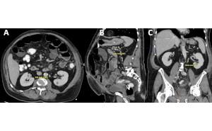 Unterschiede in der radiologischen Beurteilung retroperitonealer Lymphknoten bei Hodentumorpatienten