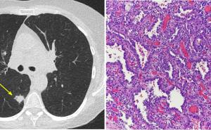 Stellungnahme zur möglichen Implementierung des Lungenkrebsscreenings mittels Low-Dose-Computertomografie (CT) im Sanitätsdienst der Bundeswehr