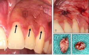 Snus-induzierte orale submuköse Fibrose – ein klinisch-histopathologischer Fallbericht