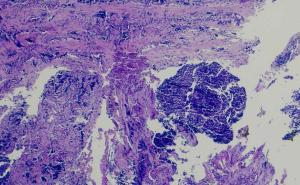 Pulmonale Raumforderung mit ungewöhnlicher Ursache