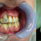 Abb. 1: Zahn 11 klinisch und radiologisch mit ausgeprägtem Defekt