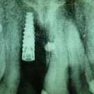 Abb. 3: Röntgenkontrolle des in situ befindlichen dentalen Implantats und...
