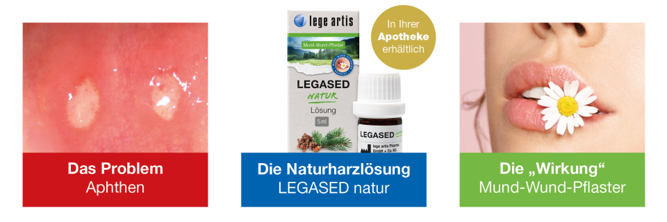 Aphthe, Apthe oder Afte? Hauptsache weg damit!