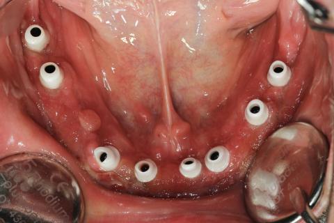 Eingegliederte Zirkonoxidprimärkronen auf den Implantaten des Unterkiefers...