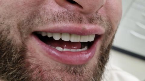 Patient von extraoral mit eingesetzten Prothesen