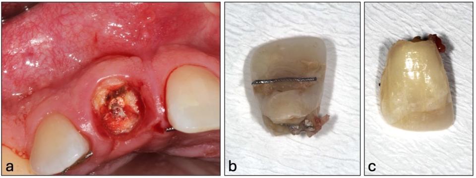 Abbildung 2: Befund. a. nach Entfernung des Retainers und Fragment, b. und c....