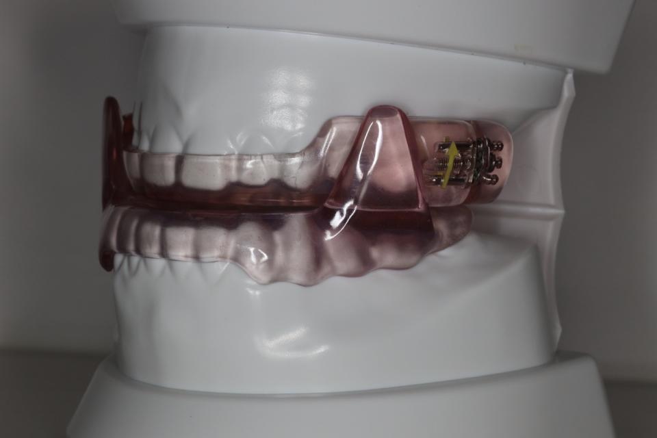 Unterkieferprotrusionsschiene