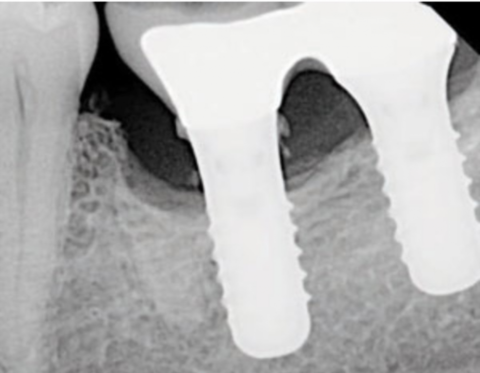 Radiologisch sichtbare Zementreste an einer zementierten Implantatkrone