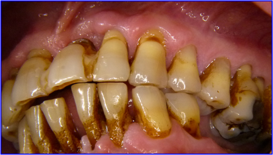 Zahnbeläge, Zahnfleischrückgang und starke Entzündungszeichen bei einer...