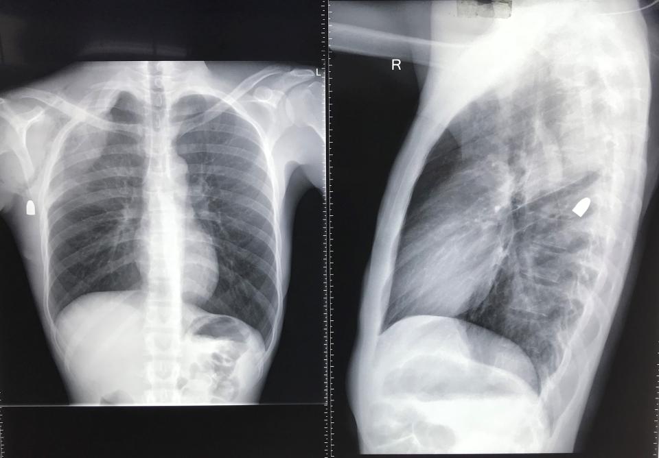 Röntgenbilder Thorax