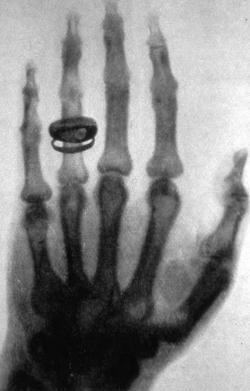Röntgenaufnahme der linken Hand von Albert Kölliker