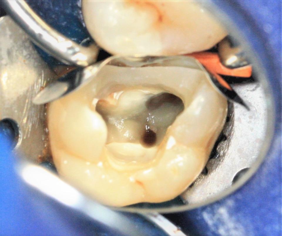 Überweisungsfall Zahn 17 – vor weiteren endodontischen Maßnahmen wurde die...